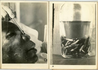 MEDICAL - NOT FOR THE SQUEAMISH - 1935 AFRICAN AMERICAN MAN WITH WORMS