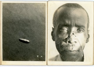 MEDICAL - NOT FOR THE SQUEAMISH - 1935 AFRICAN AMERICAN MAN WITH WORMS