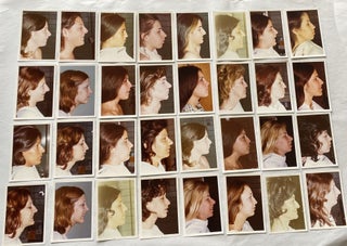 Item #304 RHINOPLASTY BEFORE PHOTOS late 1960s - early 1980s