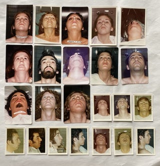 RHINOPLASTY BEFORE PHOTOS late 1960s - early 1980s