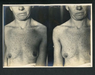 VENEREAL DISEASE MEDICAL PHOTO ALBUM 1910s