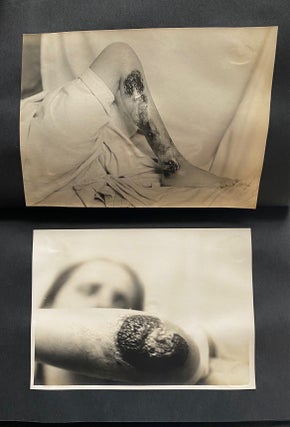 VENEREAL DISEASE MEDICAL PHOTO ALBUM 1910s