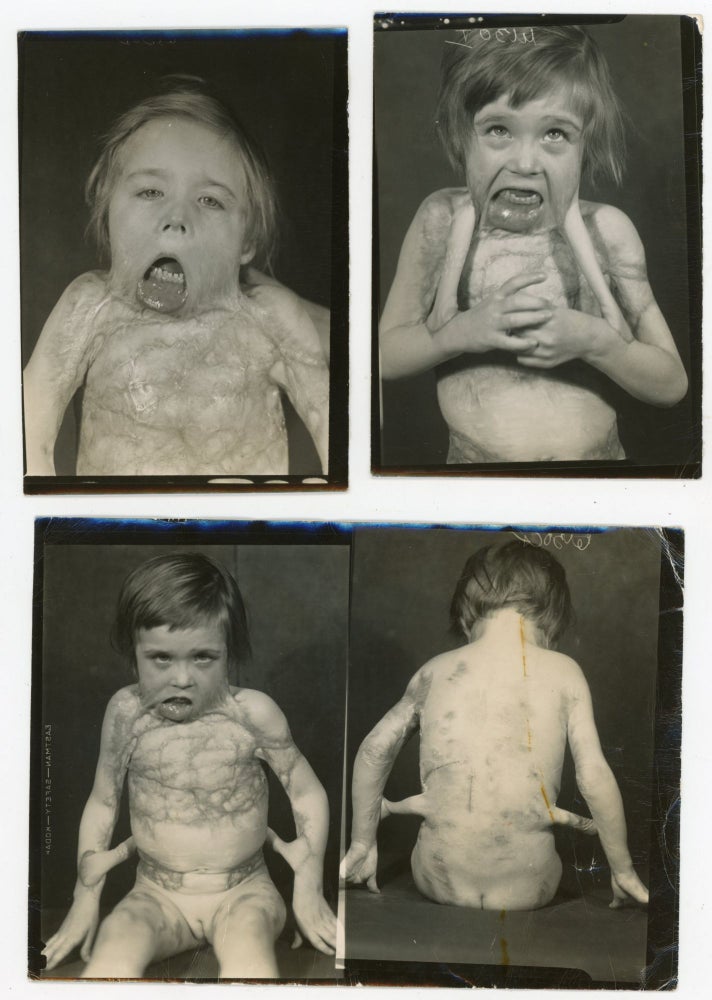 Item #87 CHILD WITH SEVERE DEFORMITIES, PERHAPS FROM BURNS, OVER THE YEARS - MEDICAL PHOTOS