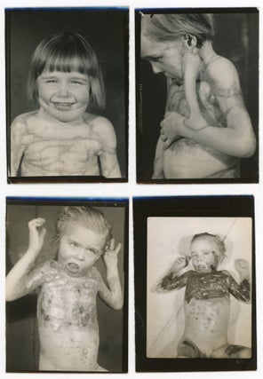 CHILD WITH SEVERE DEFORMITIES, PERHAPS FROM BURNS, OVER THE YEARS - MEDICAL PHOTOS