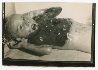CHILD WITH SEVERE DEFORMITIES, PERHAPS FROM BURNS, OVER THE YEARS - MEDICAL PHOTOS