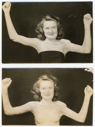 CHILD WITH SEVERE DEFORMITIES, PERHAPS FROM BURNS, OVER THE YEARS - MEDICAL PHOTOS
