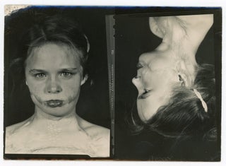 CHILD WITH SEVERE DEFORMITIES, PERHAPS FROM BURNS, OVER THE YEARS - MEDICAL PHOTOS